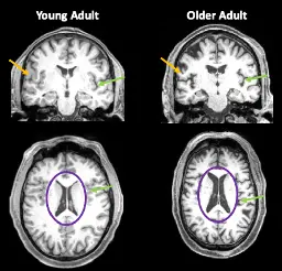 Even Mild Cases Of COVID-19 Can Leave A Mark On The Brain, Such As Reductions In Gray Matter